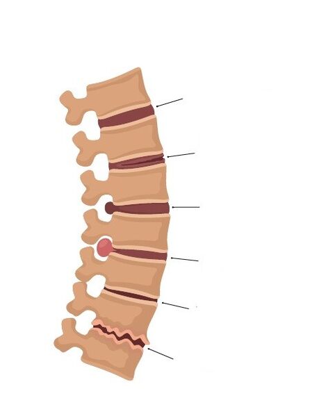 changes in the bones of the spine