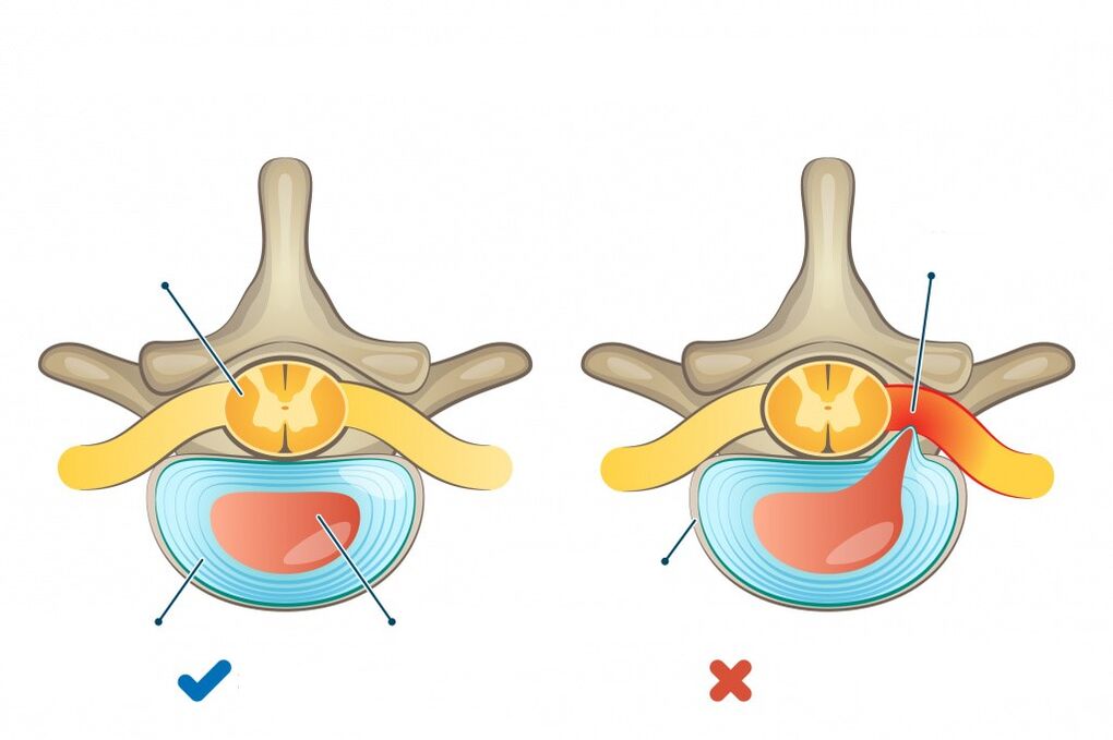 intervertebral discs - one healthy, the other herniated