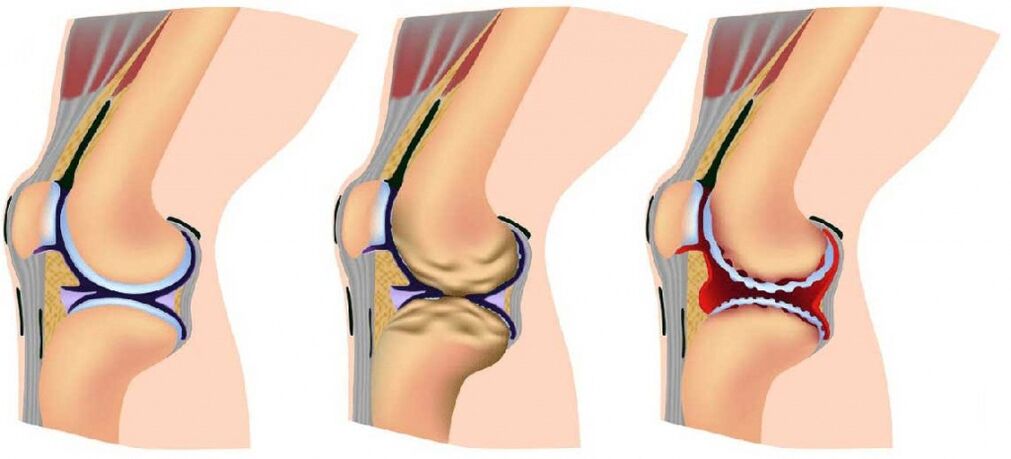 Sturdy becomes and affected by arthrosis