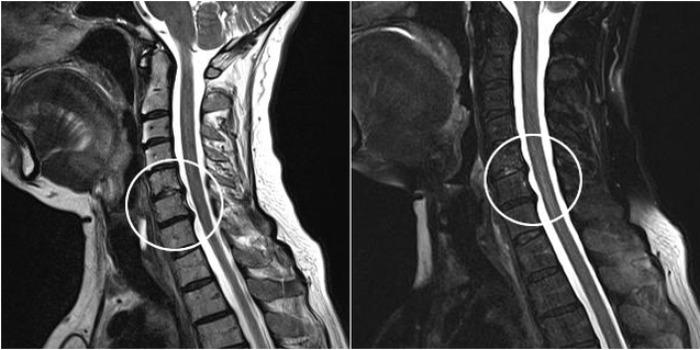 cervical osteochondrosis on nuclear magnetic resonance