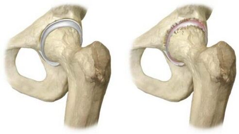 healthy and arthritic hip joint